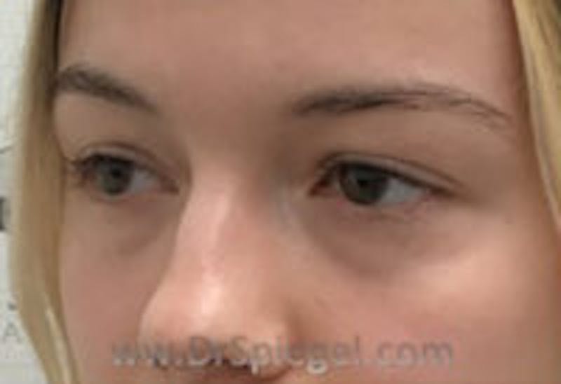 Tear Trough / Under Eye Fillers Before & After Gallery - Patient 157140828 - Image 3