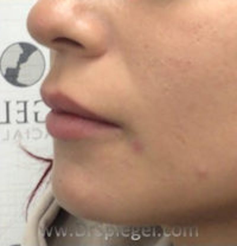 Lip Filler Before & After Gallery - Patient 157140829 - Image 3