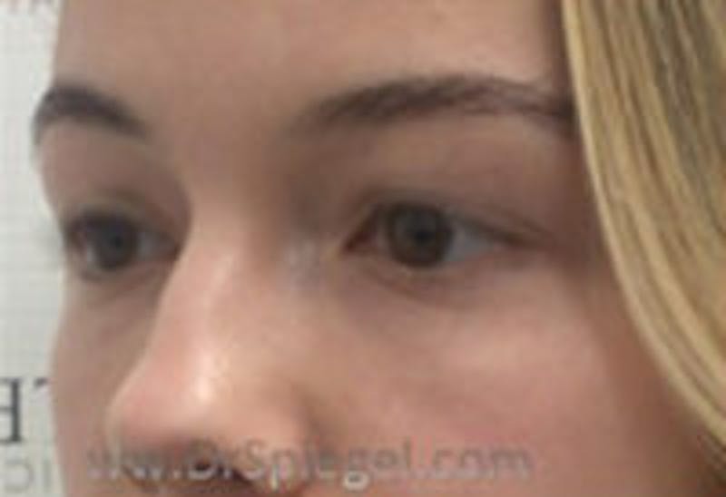Tear Trough / Under Eye Fillers Before & After Gallery - Patient 157140828 - Image 4