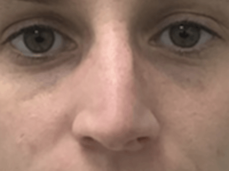 Non-Surgical Rhinoplasty / Nose Filler Before & After Gallery - Patient 157140831 - Image 1