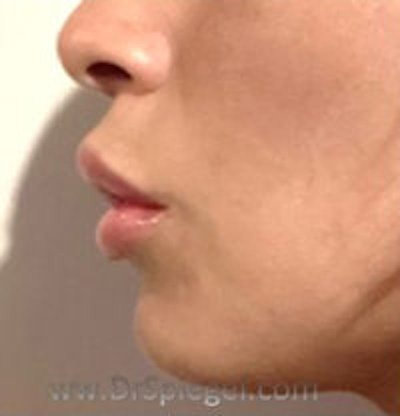 Lip Filler Before & After Gallery - Patient 157140829 - Image 4