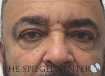 Tear Trough / Under Eye Fillers Before & After Gallery - Patient 157140832 - Image 1