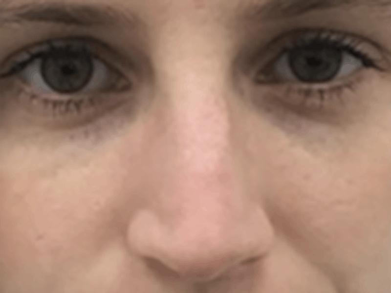 Non-Surgical Rhinoplasty / Nose Filler Before & After Gallery - Patient 157140831 - Image 2