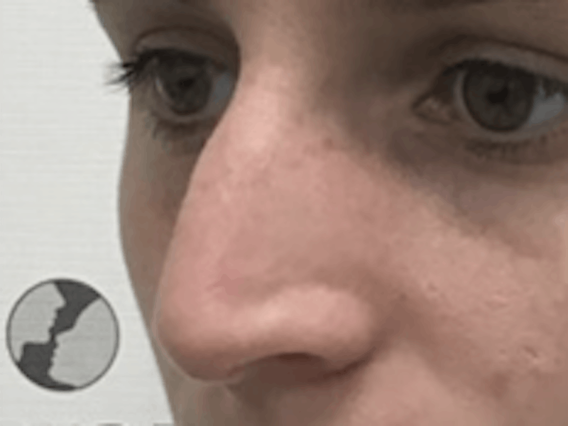Non-Surgical Rhinoplasty / Nose Filler Before & After Gallery - Patient 157140831 - Image 3