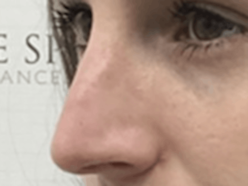 Non-Surgical Rhinoplasty / Nose Filler Before & After Gallery - Patient 157140831 - Image 4