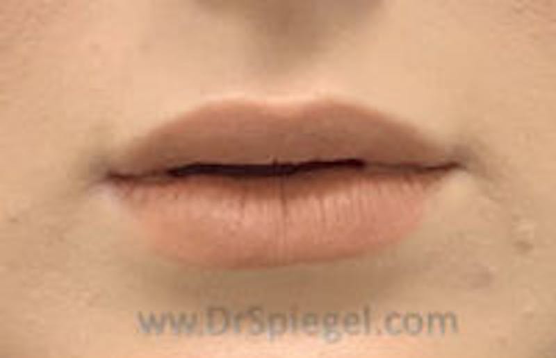 Lip Filler Before & After Gallery - Patient 157140834 - Image 2
