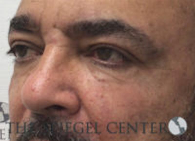 Tear Trough / Under Eye Fillers Before & After Gallery - Patient 157140832 - Image 4