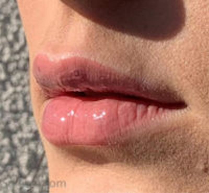 Lip Filler Before & After Gallery - Patient 157140834 - Image 4