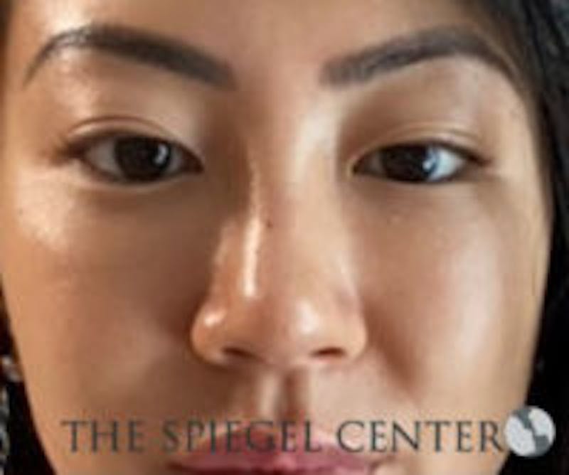 Non-Surgical Rhinoplasty / Nose Filler Before & After Gallery - Patient 157140835 - Image 2