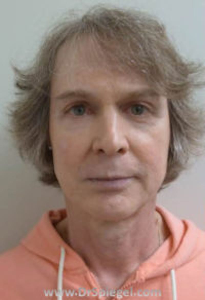 FFS Before & After Gallery - Patient 157140836 - Image 1