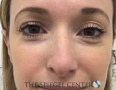 Non-Surgical Rhinoplasty / Nose Filler Before & After Gallery - Patient 157140844 - Image 1