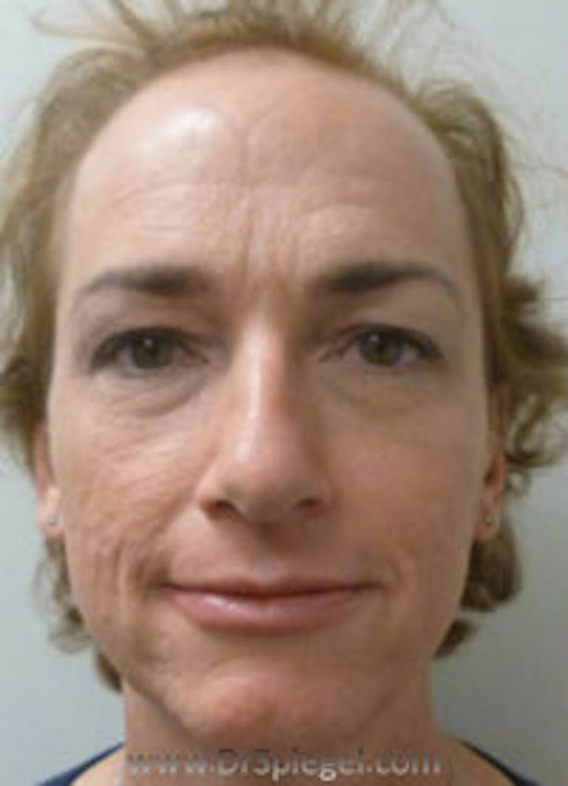 FFS Before & After Gallery - Patient 157140843 - Image 1