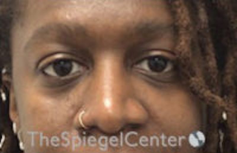 Tear Trough / Under Eye Fillers Before & After Gallery - Patient 157140845 - Image 1