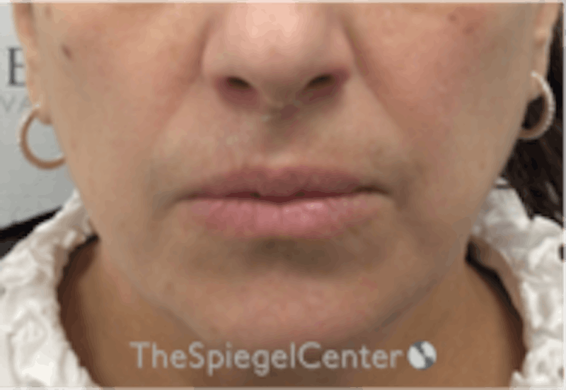 Lip Filler Before & After Gallery - Patient 157140846 - Image 1