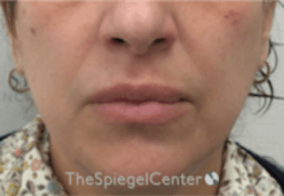 Lip Filler Before & After Gallery - Patient 157140846 - Image 2