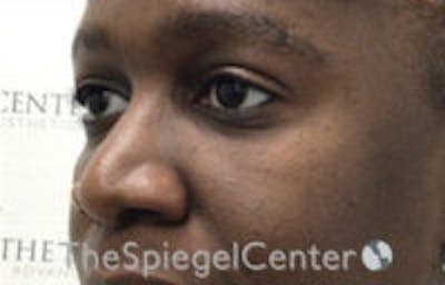 Tear Trough / Under Eye Fillers Before & After Gallery - Patient 157140845 - Image 4