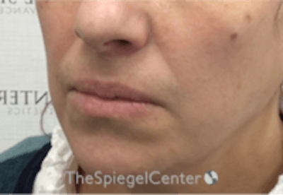 Lip Filler Before & After Gallery - Patient 157140846 - Image 3