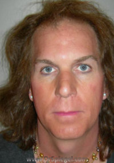 FFS Before & After Gallery - Patient 157140847 - Image 1