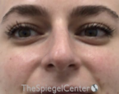 Non-Surgical Rhinoplasty / Nose Filler Before & After Gallery - Patient 157140848 - Image 1