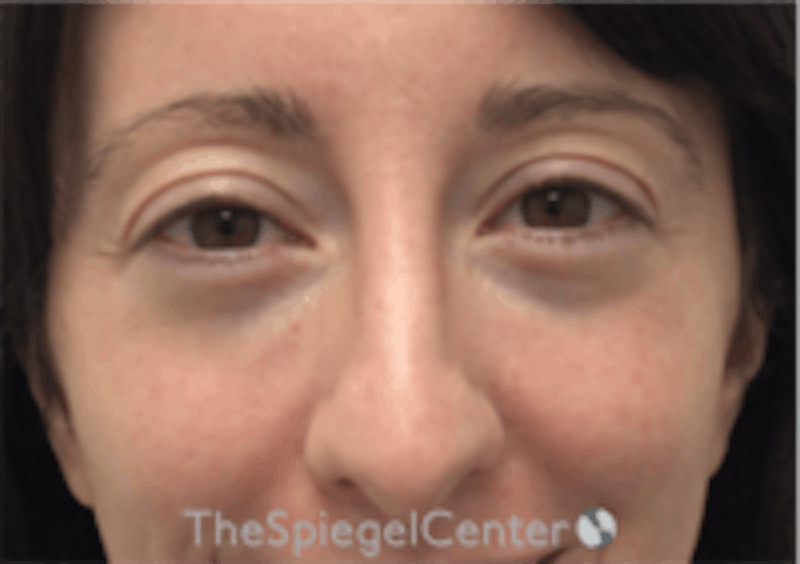 Tear Trough / Under Eye Fillers Before & After Gallery - Patient 157140850 - Image 1