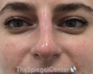 Non-Surgical Rhinoplasty / Nose Filler Before & After Gallery - Patient 157140848 - Image 2