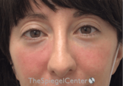 Tear Trough / Under Eye Fillers Before & After Gallery - Patient 157140850 - Image 2