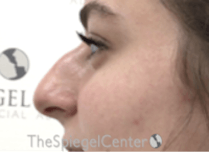 Non-Surgical Rhinoplasty / Nose Filler Before & After Gallery - Patient 157140848 - Image 3