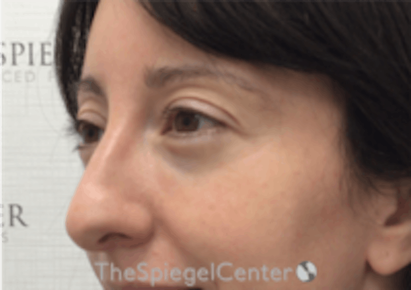 Tear Trough / Under Eye Fillers Before & After Gallery - Patient 157140850 - Image 3