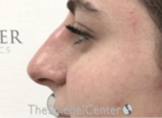 Non-Surgical Rhinoplasty / Nose Filler Before & After Gallery - Patient 157140848 - Image 4