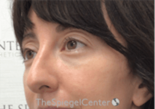 Tear Trough / Under Eye Fillers Before & After Gallery - Patient 157140850 - Image 4