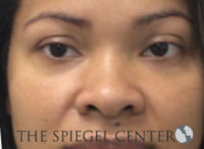 Non-Surgical Rhinoplasty / Nose Filler Before & After Gallery - Patient 157140853 - Image 1