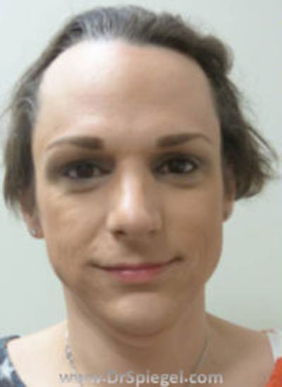 FFS Before & After Gallery - Patient 157140852 - Image 1