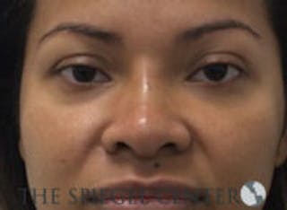 Non-Surgical Rhinoplasty / Nose Filler Before & After Gallery - Patient 157140853 - Image 2