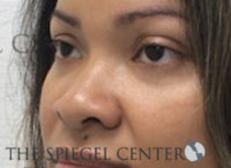 Non-Surgical Rhinoplasty / Nose Filler Before & After Gallery - Patient 157140853 - Image 3