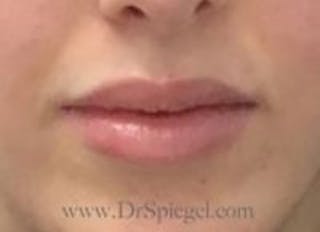 Lip Filler Before & After Gallery - Patient 157140855 - Image 2
