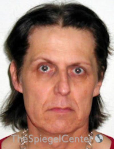 FFS Before & After Gallery - Patient 157140857 - Image 1