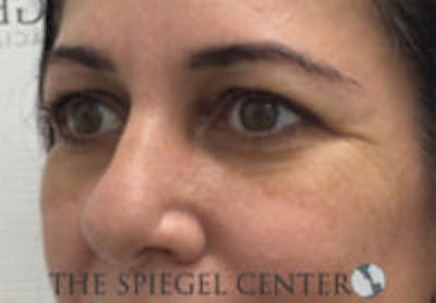 Tear Trough / Under Eye Fillers Before & After Gallery - Patient 157140854 - Image 3