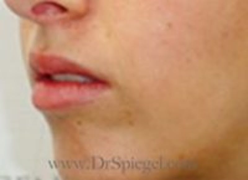 Lip Filler Before & After Gallery - Patient 157140855 - Image 3