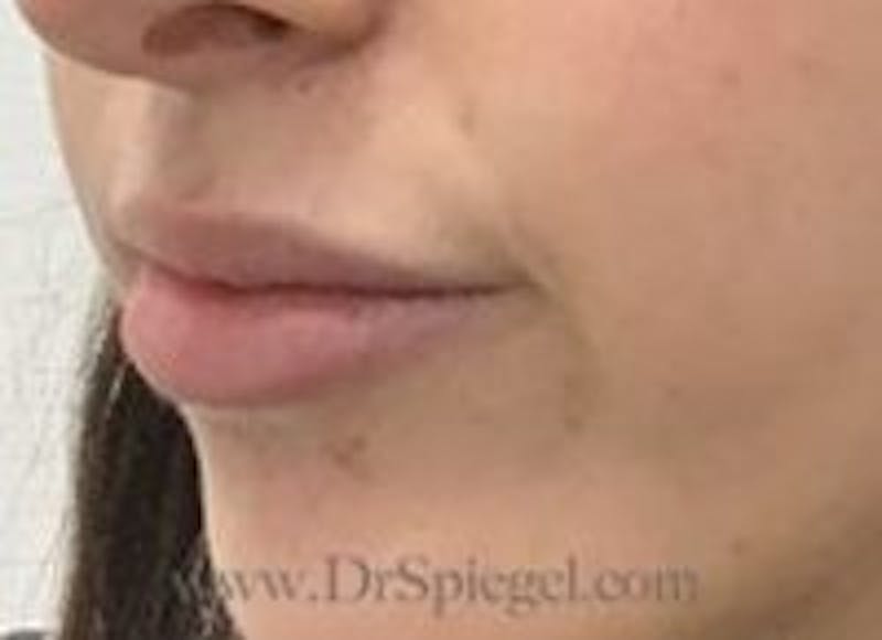Lip Filler Before & After Gallery - Patient 157140855 - Image 4