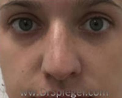 Non-Surgical Rhinoplasty / Nose Filler Before & After Gallery - Patient 157140859 - Image 1