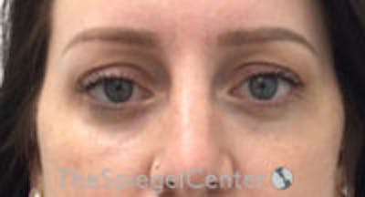 Tear Trough / Under Eye Fillers Before & After Gallery - Patient 157140861 - Image 1