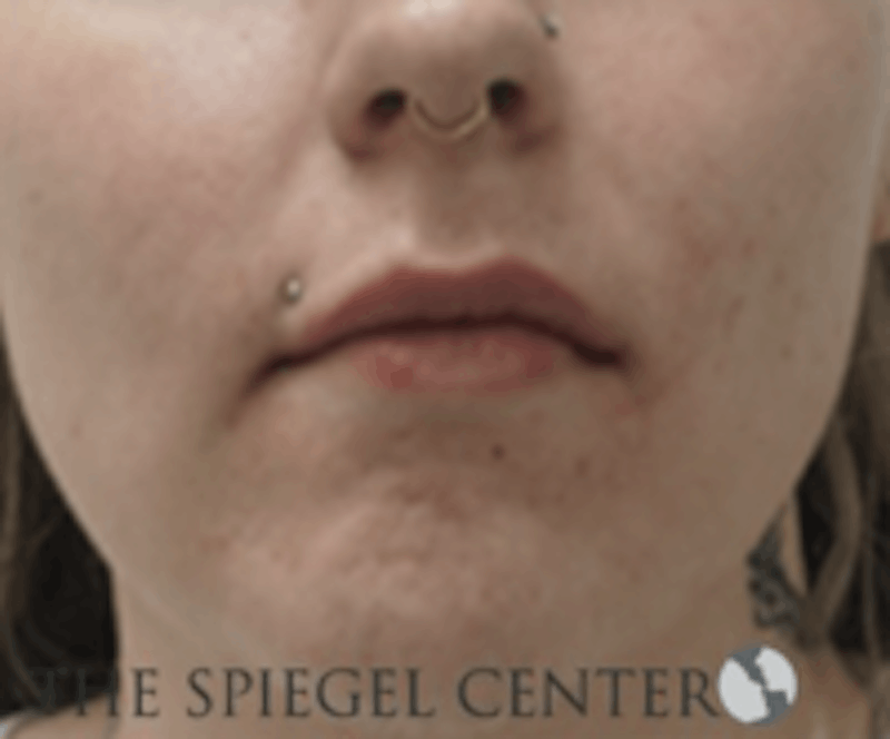 Lip Filler Before & After Gallery - Patient 157140862 - Image 1
