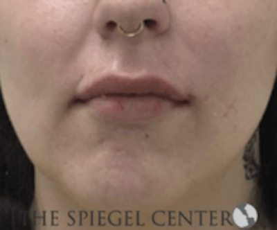 Lip Filler Before & After Gallery - Patient 157140862 - Image 2