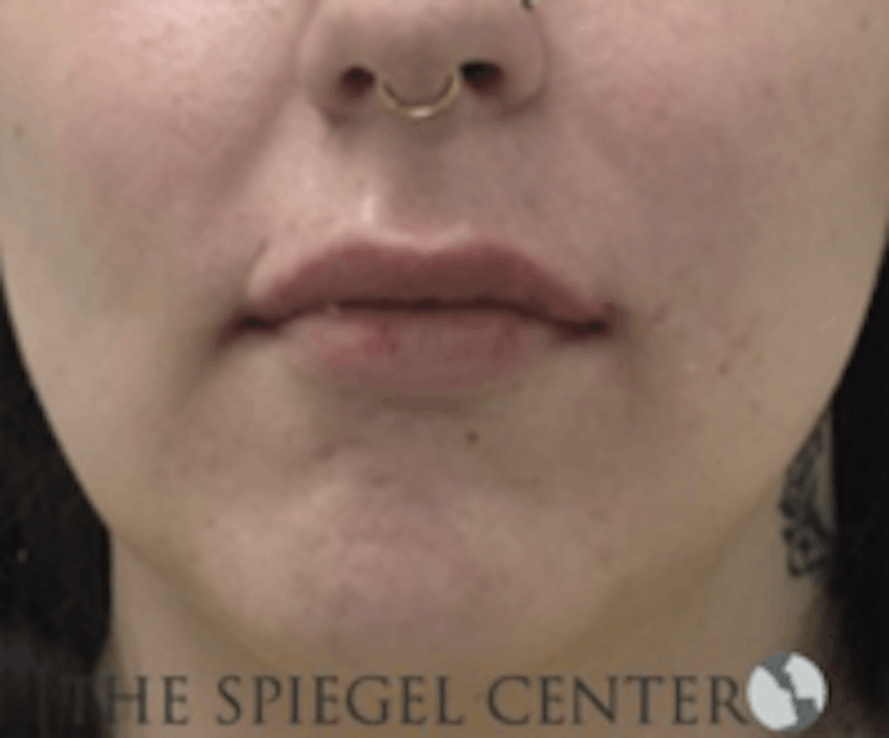 Lip Filler Before & After Gallery - Patient 157140862 - Image 2