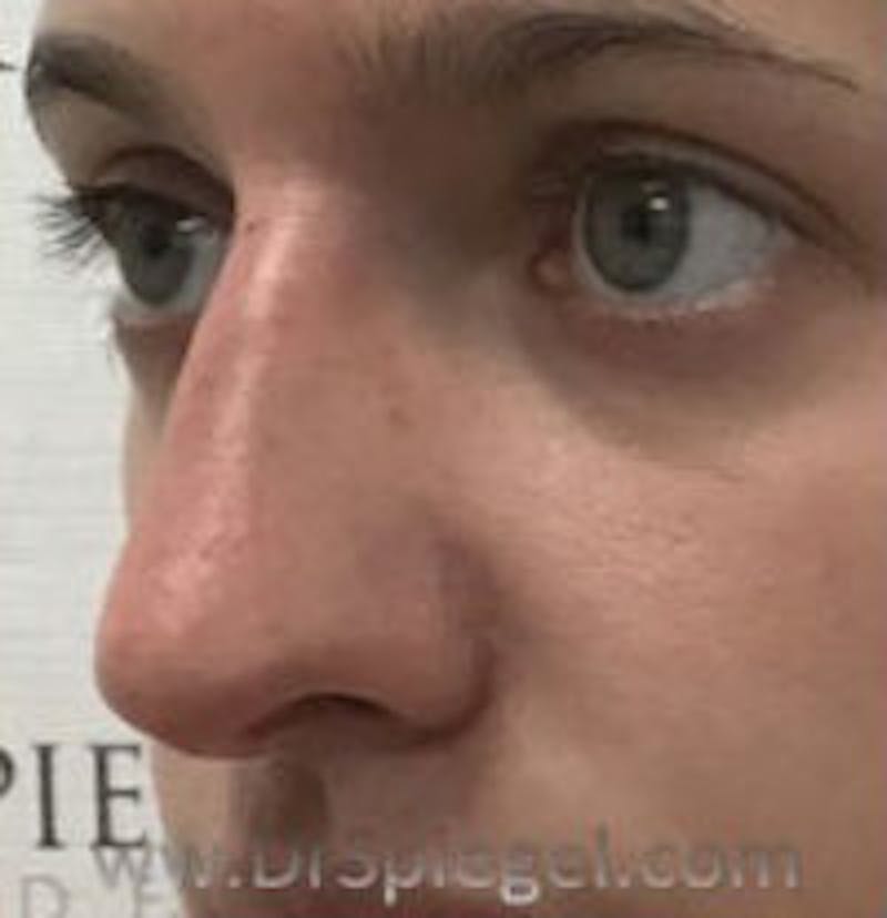 Non-Surgical Rhinoplasty / Nose Filler Before & After Gallery - Patient 157140859 - Image 4
