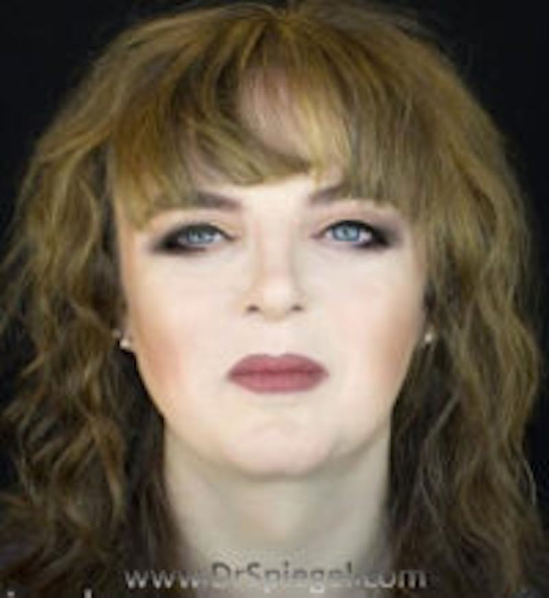 FFS Before & After Gallery - Patient 157140860 - Image 2