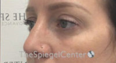 Tear Trough / Under Eye Fillers Before & After Gallery - Patient 157140861 - Image 4