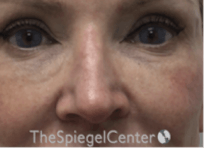 Non-Surgical Rhinoplasty / Nose Filler Before & After Gallery - Patient 157140865 - Image 1