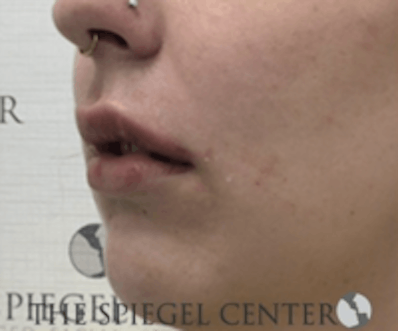 Lip Filler Before & After Gallery - Patient 157140862 - Image 4