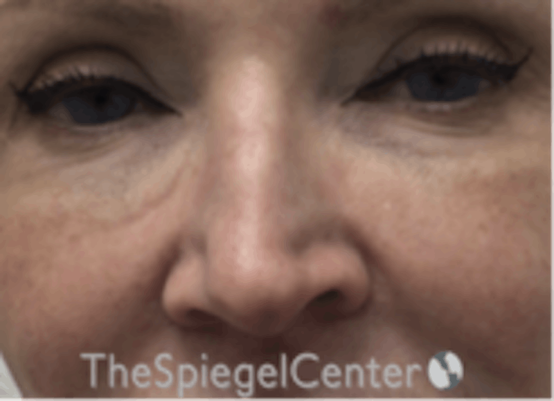 Non-Surgical Rhinoplasty / Nose Filler Before & After Gallery - Patient 157140865 - Image 2